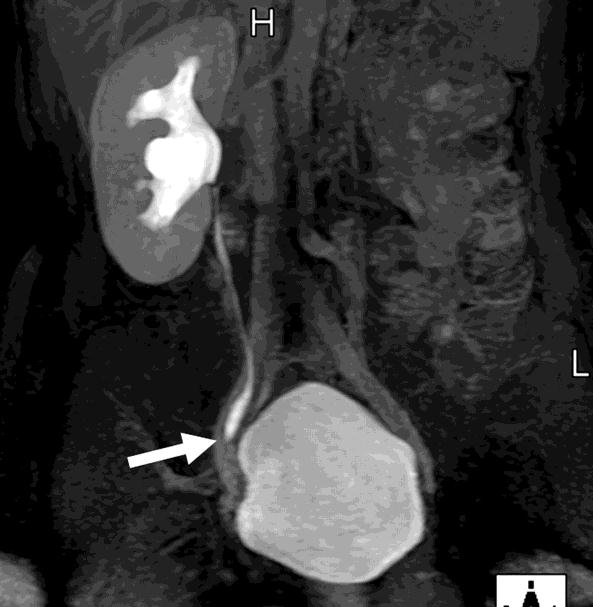 Διάγνωση και Σταδιοποίηση Αξονική τομογραφία (CT) CT spiral ct urography ενδοφλέβια