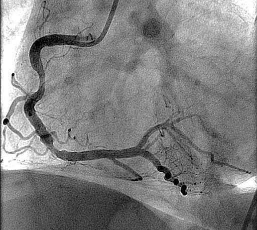 studies have, however, suggested preventive revascularisation 3,4 Non culprit 1 Jong JA al.