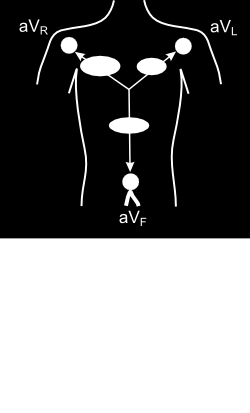 Ενισχυμένες Μονοπολικές Απαγωγές Άκρων Unipolar and Augmented Leads Αρνητικό ηλεκτρόδιο: Ταυτόχρονη σύνδεση σε δύο άκρα