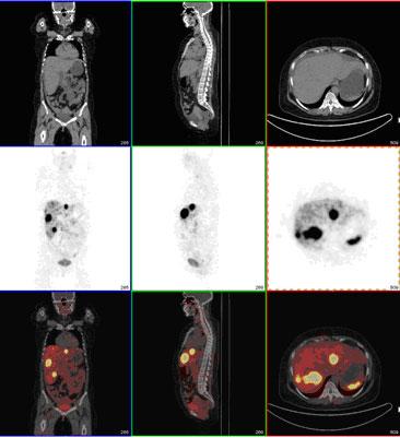 Α.1 Εισαγωγή Α Β Σχήμα Α. 4: Α. Διάταξη SPET/CT και Β. Διάταξη PET/CT A B B C C Σχήμα Α. 5: Αριστερά:.