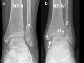 The ability of the Lauge-Hansen classification to predict ligament injury and 06/09/2013 mechanism in ankle fractures: an MRI study. J Orthop Trauma. 2006;20(4):267-72.