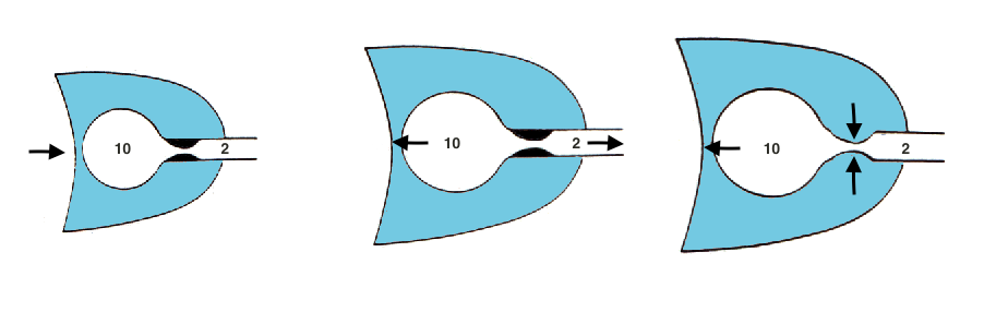 Εικόνα 2.6 Καταγραφή της ροής σε περίπτωση παγίδευσης αέρα. Η ροή κατά το τέλος της εκπνοής δεν μηδενίζεται (βέλος). Η auto-pεερ συνοδεύεται συνήθως από δυναμική υπερδιάταση.