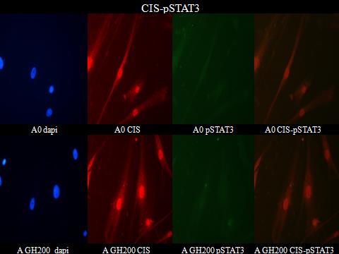 Ινοβλάστες ασθενή Εικόνα: Ασθενής (0, GH200, GH1000, EGF): dapi CIS pstat3- συγχώνευση Η κοινή εντόπιση των δύο πρωτεϊνών είναι κυτταροπλασματική και μεμβρανική και παρατηρείται κυρίως μετά από τις