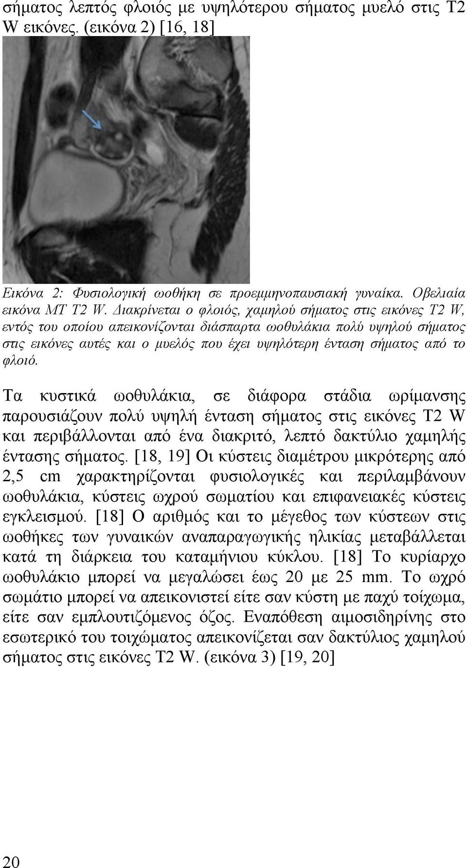 το φλοιό. Τα κυστικά ωοθυλάκια, σε διάφορα στάδια ωρίµανσης παρουσιάζουν πολύ υψηλή ένταση σήµατος στις εικόνες T2 W και περιβάλλονται από ένα διακριτό, λεπτό δακτύλιο χαµηλής έντασης σήµατος.