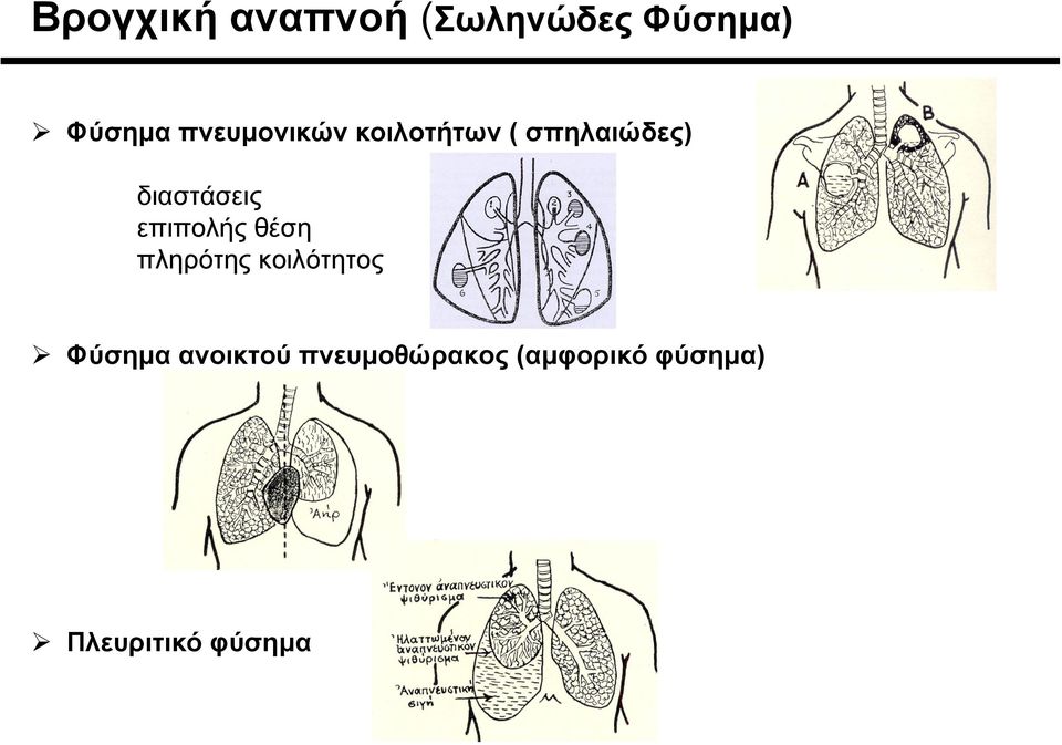 επιπολής θέση πληρότης κοιλότητος Φύσηµα