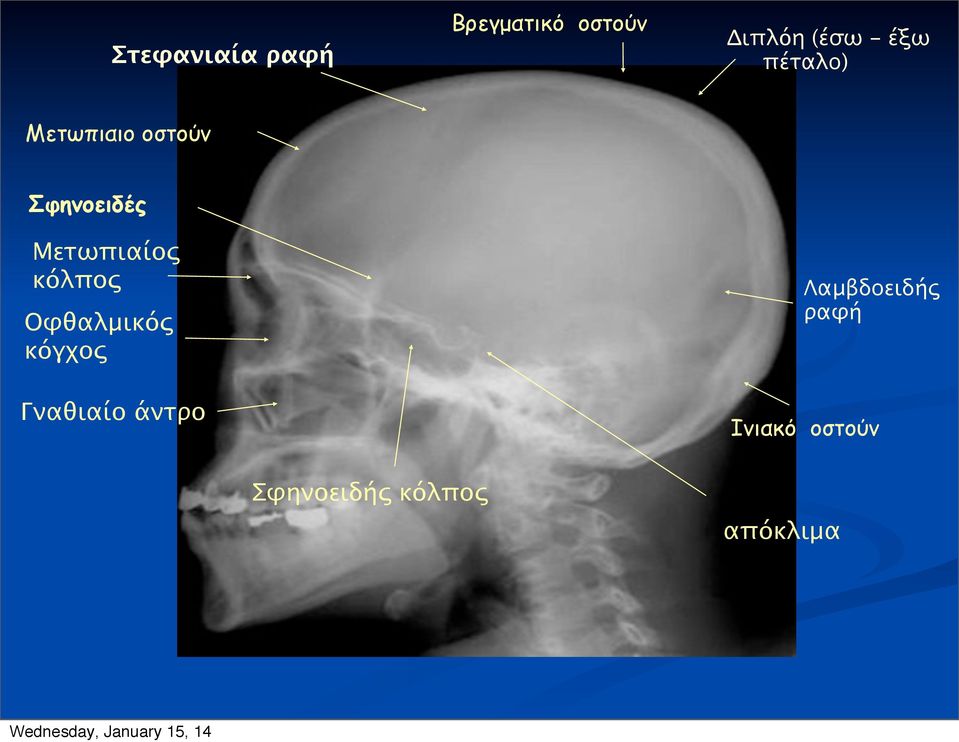 Μετωπιαίος κόλπος Οφθαλμικός κόγχος Λαμβδοειδής