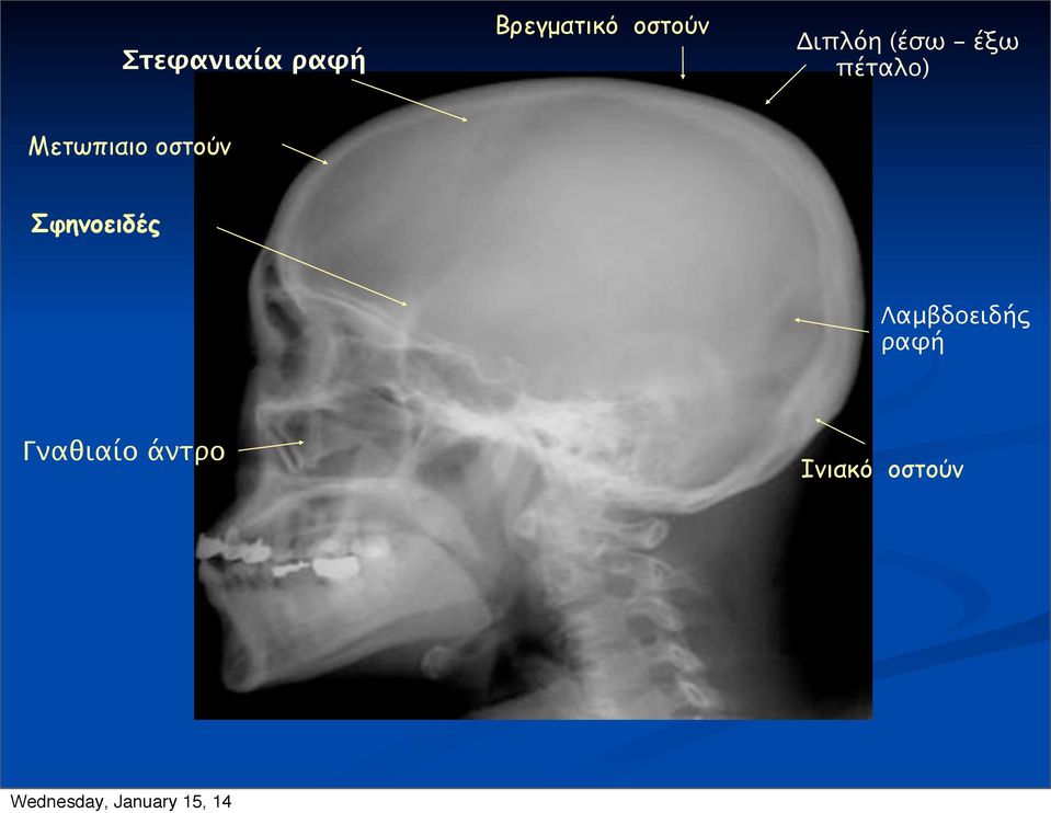 Μετωπιαιο οστούν Σφηνοειδές