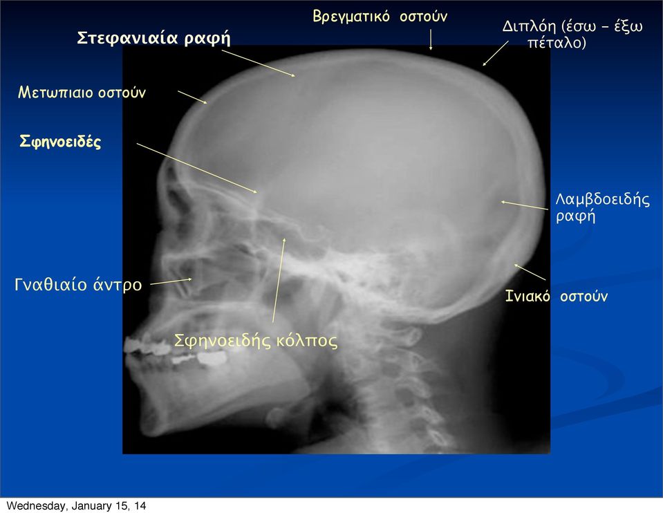 οστούν Σφηνοειδές Λαμβδοειδής ραφή