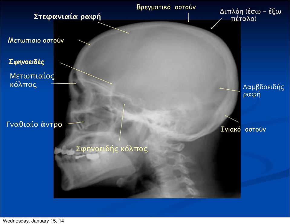 Σφηνοειδές Μετωπιαίος κόλπος Λαμβδοειδής