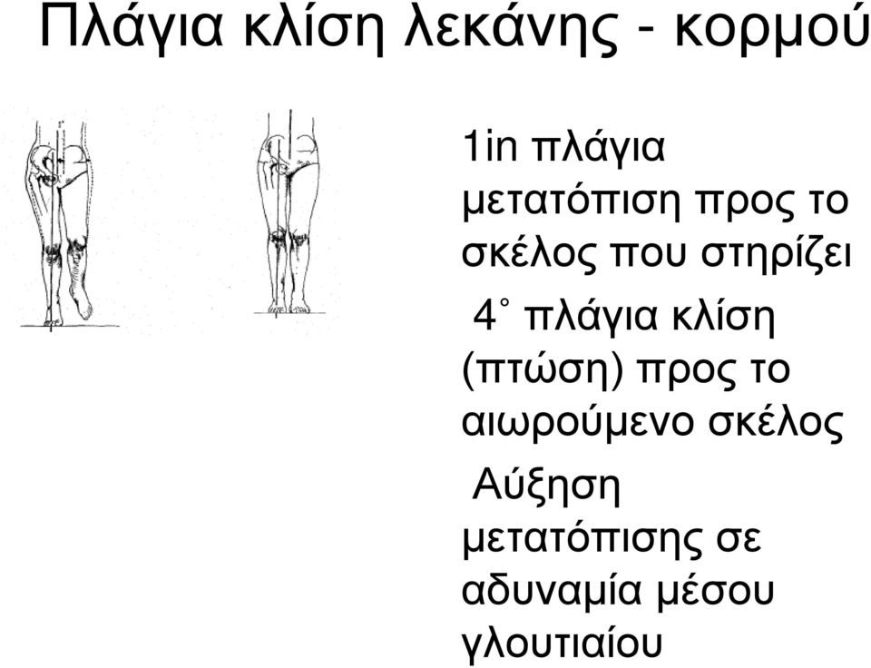 πλάγια κλίση (πτώση) προς το αιωρούμενο