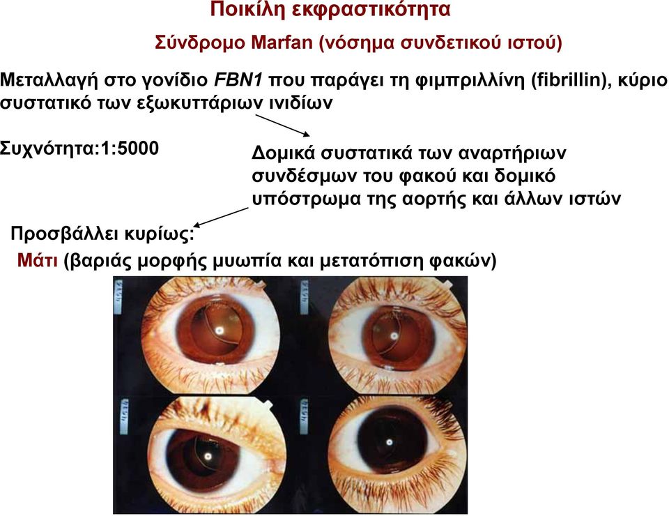 Συχνότητα:1:5000 Δομικά συστατικά των αναρτήριων συνδέσμων του φακού και δομικό υπόστρωμα