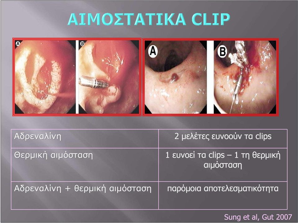 clips 1 ευνοεί τα clips 1 τη θερμική