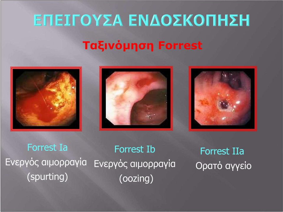 Forrest Ib Ενεργός αιμορραγία