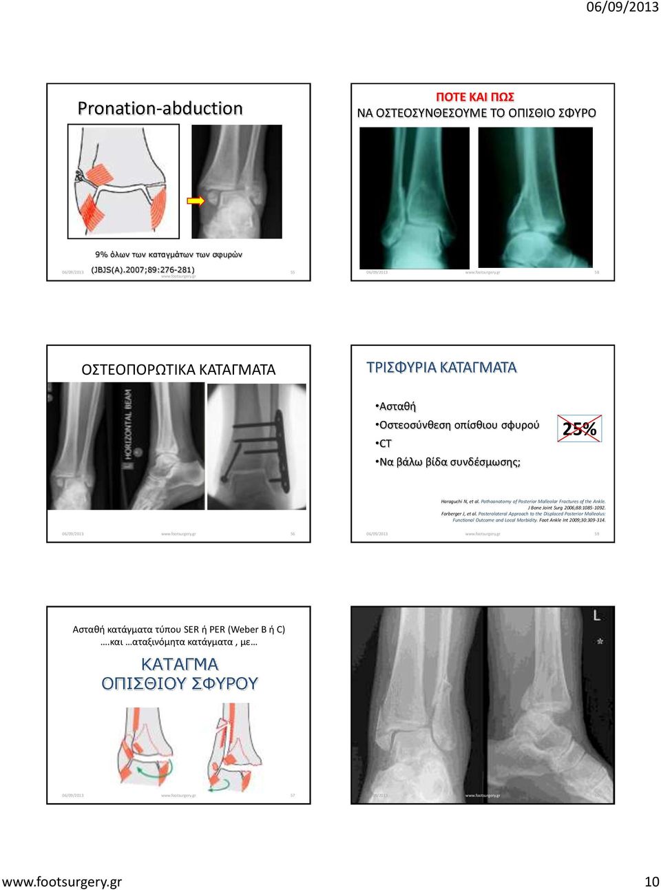 Pathoanatomy of Posterior Malleolar Fractures of the Ankle. J Bone Joint Surg 2006;88:1085-1092. Forberger J, et al.