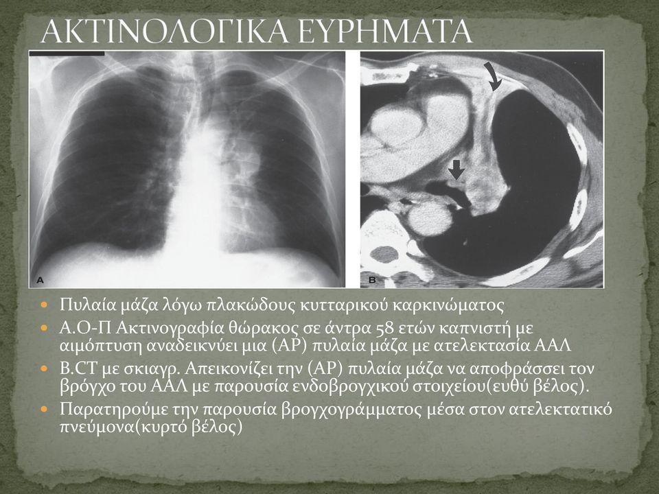 με ατελεκτασία ΑΑΛ Β.CT με σκιαγρ.