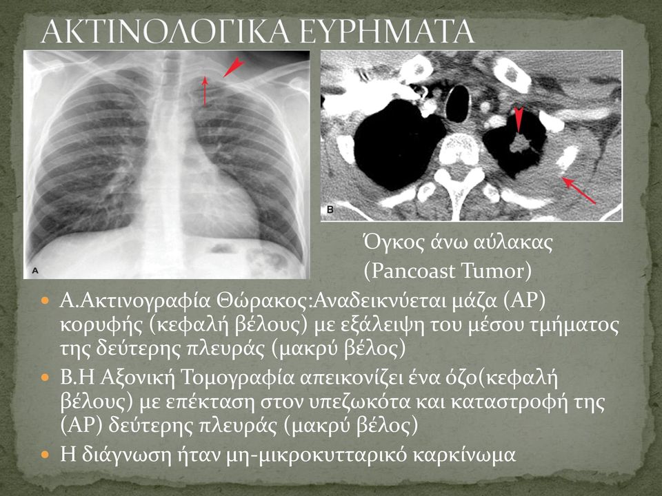 μέσου τμήματος της δεύτερης πλευράς (μακρύ βέλος) Β.