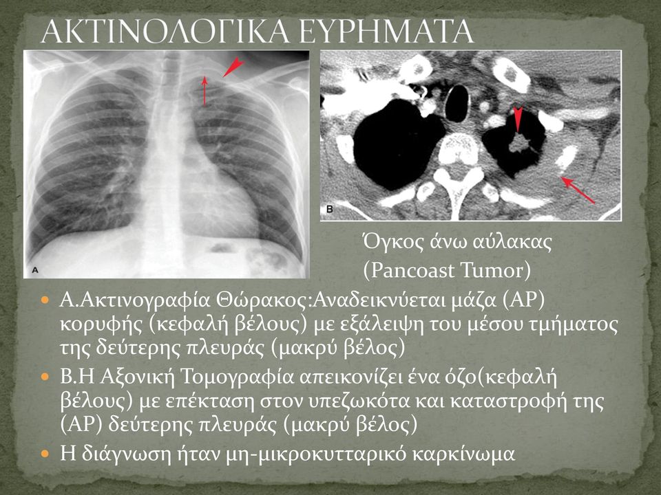 μέσου τμήματος της δεύτερης πλευράς (μακρύ βέλος) Β.