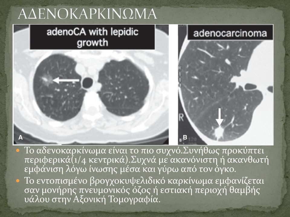 συχνά με ακανόνιστη ή ακανθωτή εμφάνιση λόγω ίνωσης μέσα και γύρω από τον