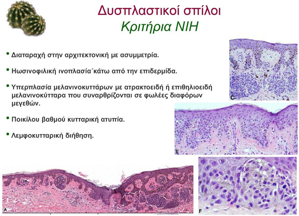 Υπερπλασία μελανινοκυττάρων με ατρακτοειδή ή επιθηλιοειδή