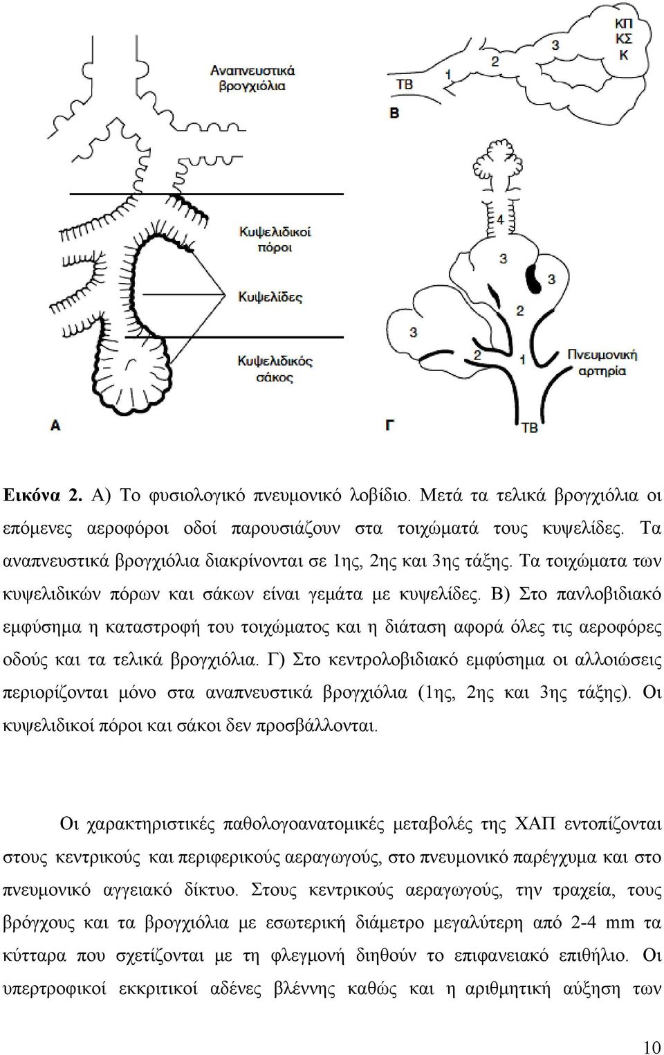 Β) Στο πανλοβιδιακό εμφύσημα η καταστροφή του τοιχώματος και η διάταση αφορά όλες τις αεροφόρες οδούς και τα τελικά βρογχιόλια.