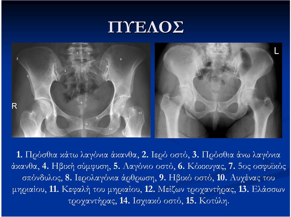 5ος οσφυϊκός σπόνδυλος, 8. Ιερολαγόνια άρθρωση, 9. Ηβικό οστό, 10.