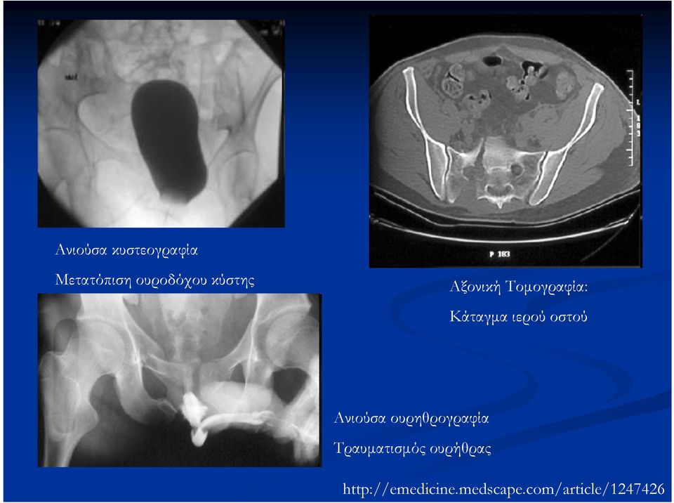 οστού Ανιούσα ουρηθρογραφία Τραυματισμός