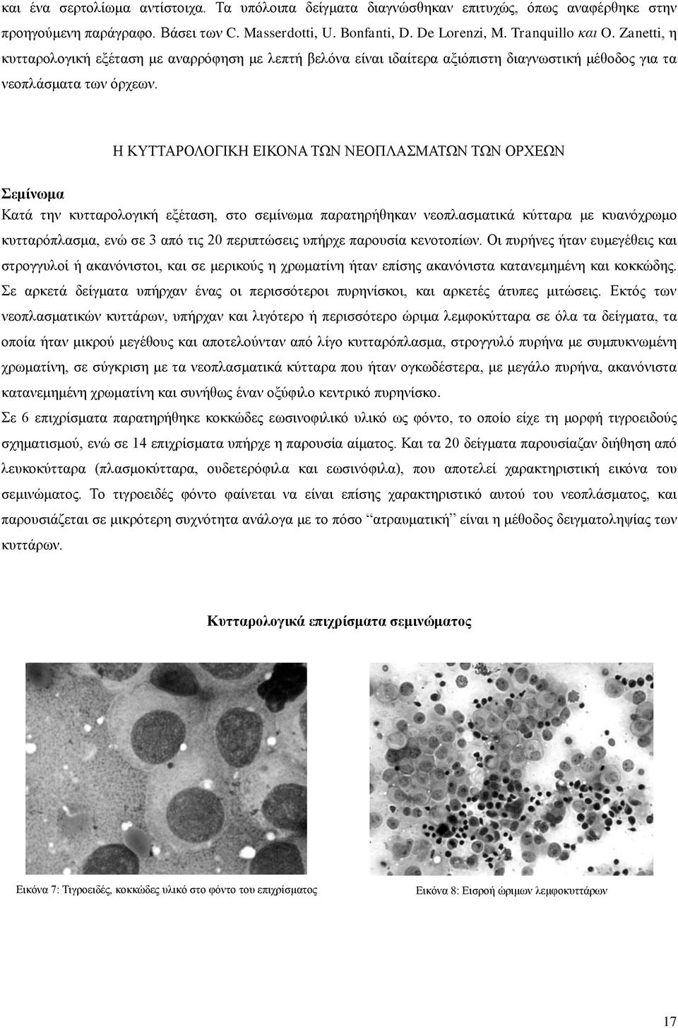 Η ΚΥΤΤΑΡΟΛΟΓΙΚΗ ΕΙΚΟΝΑ ΤΩΝ ΝΕΟΠΛΑΣΜΑΤΩΝ ΤΩΝ ΟΡΧΕΩΝ Σεμίνωμα Κατά την κυτταρολογική εξέταση, στο σεμίνωμα παρατηρήθηκαν νεοπλασματικά κύτταρα με κυανόχρωμο κυτταρόπλασμα, ενώ σε 3 από τις 20