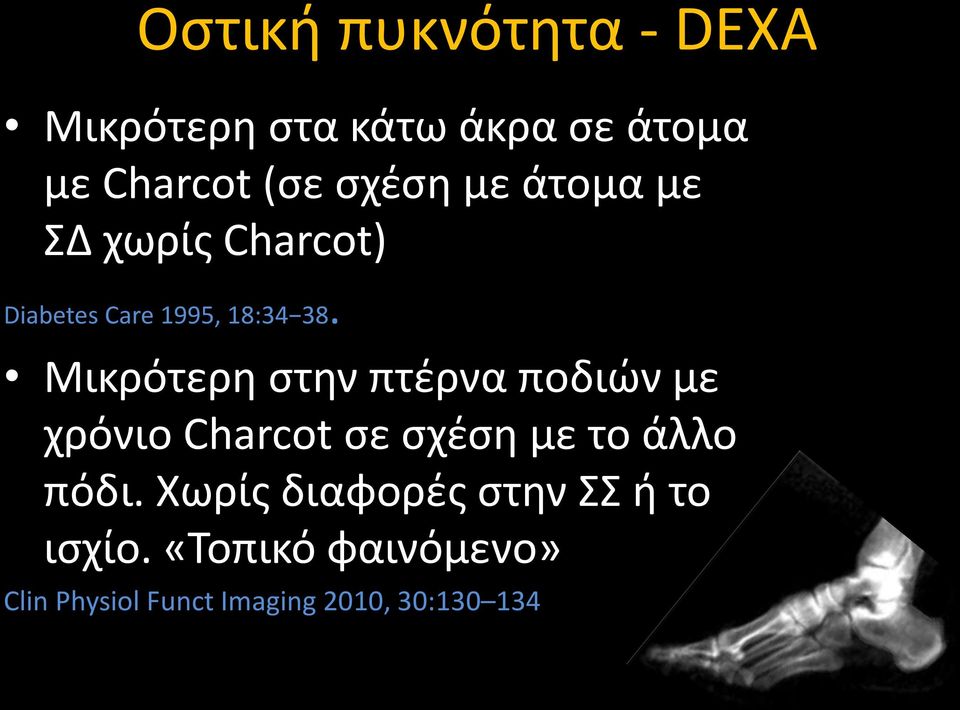 Μικρότερη στην πτέρνα ποδιών με χρόνιο Charcot σε σχέση με το άλλο πόδι.