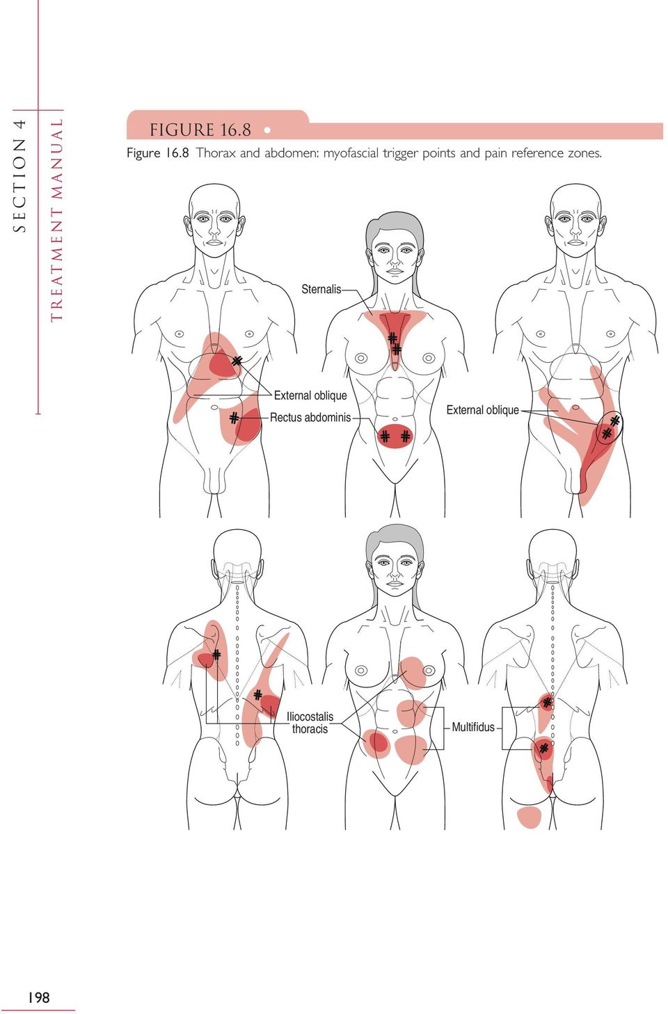 pain reference zones.