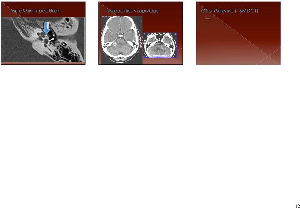 120 ma 180 facial bones 60 sinuses (low dose) Rotation Time 0.5sec Raw Slice Thickness 16x0.