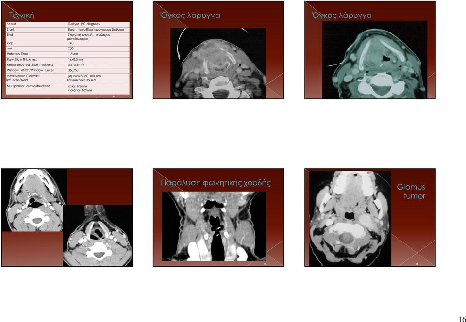 woman with hoarseness and right recurrent laryngeal nerve paralysis who underwent axial contrast-enhanced CT.