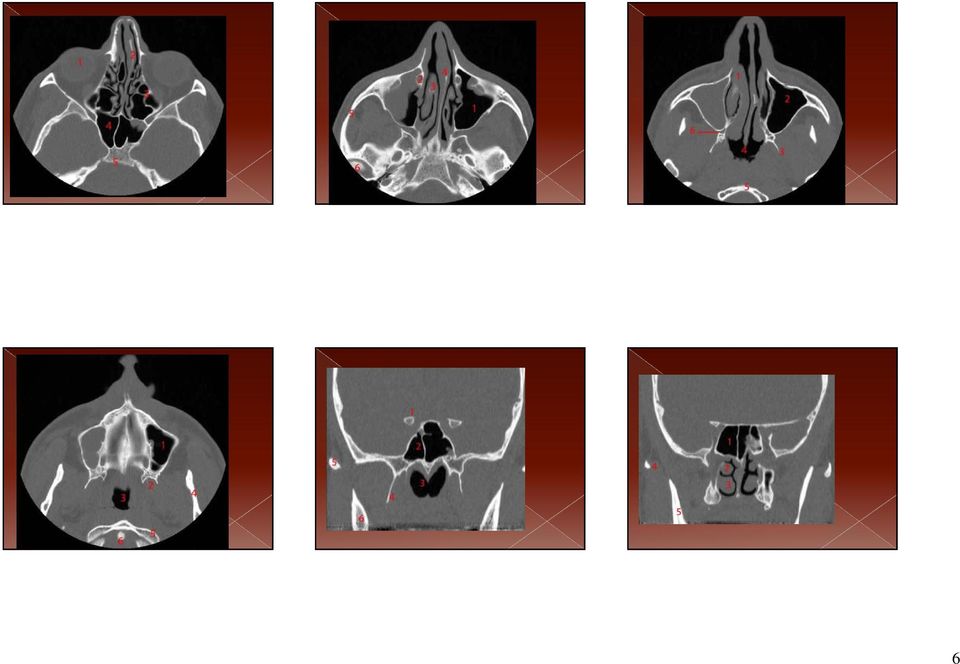 1, Maxillary sinus. 2, pterygoid process. 3, Rhinopharynx. 4, Mandible. 5, Atlas: anterior arch. 6, Odontoid process (dens) of the axis. 1, Anterior clinoid process.