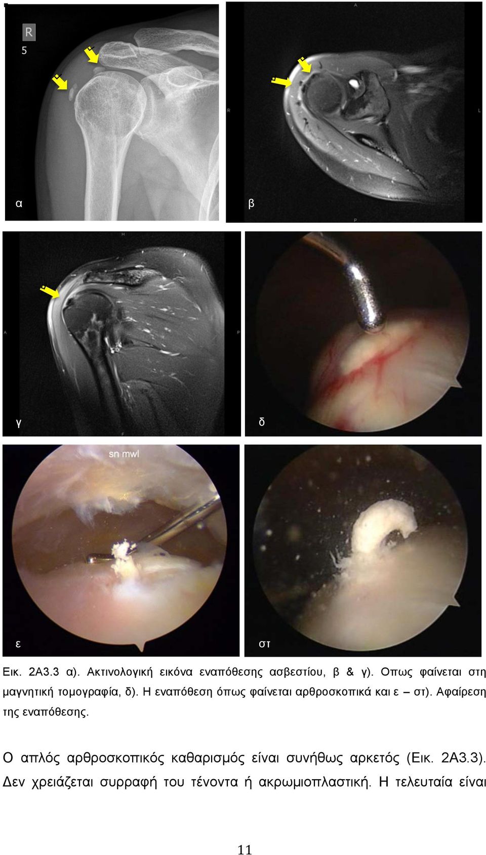 Η εναπόθεση όπως φαίνεται αρθροσκοπικά και ε στ). Αφαίρεση της εναπόθεσης.