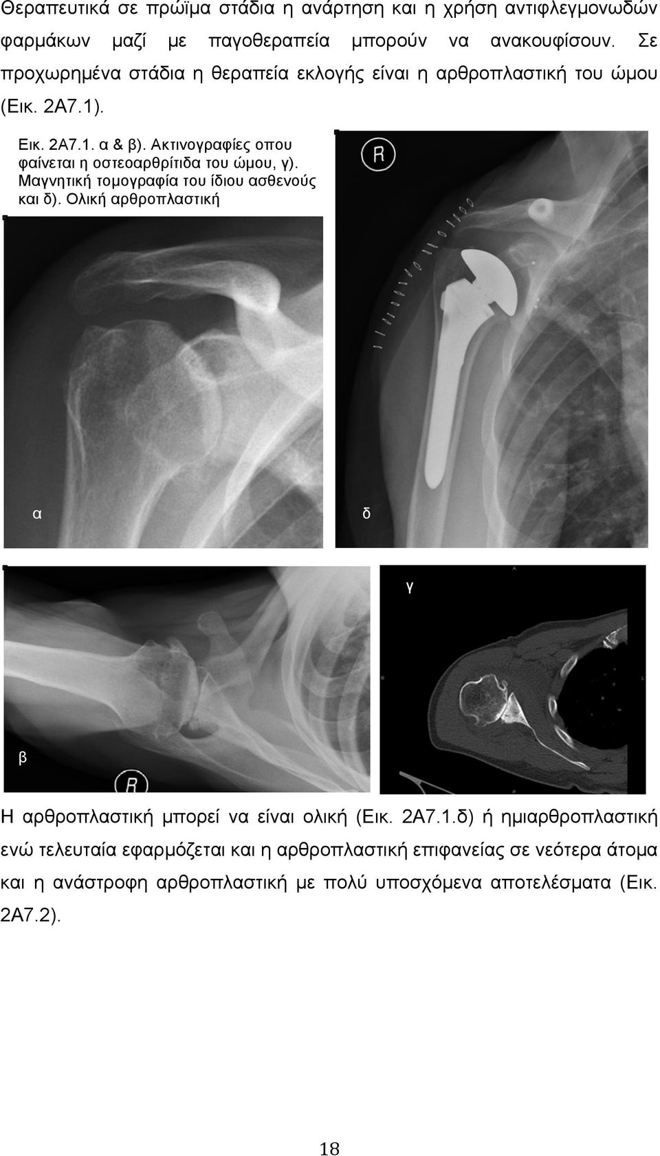 Ακτινογραφίες οπου φαίνεται η οστεοαρθρίτιδα του ώµου, γ). Μαγνητική τοµογραφία του ίδιου ασθενούς και δ).