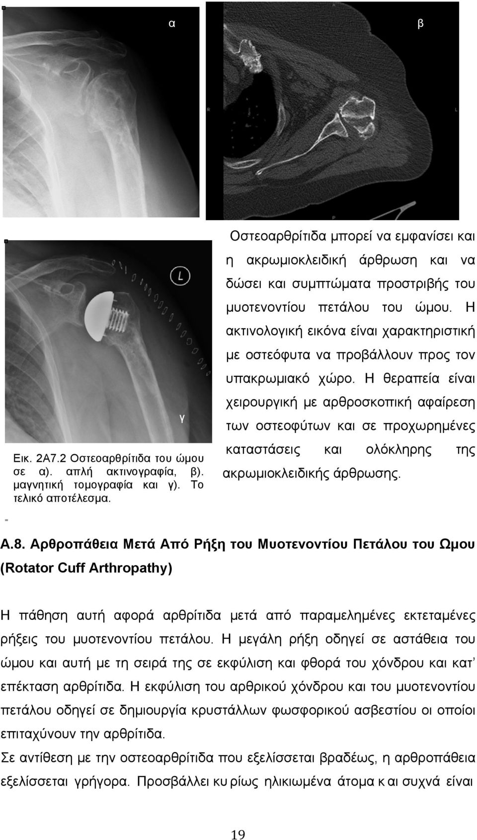 Η ακτινολογική εικόνα είναι χαρακτηριστική µε οστεόφυτα να προβάλλουν προς τον υπακρωµιακό χώρο.