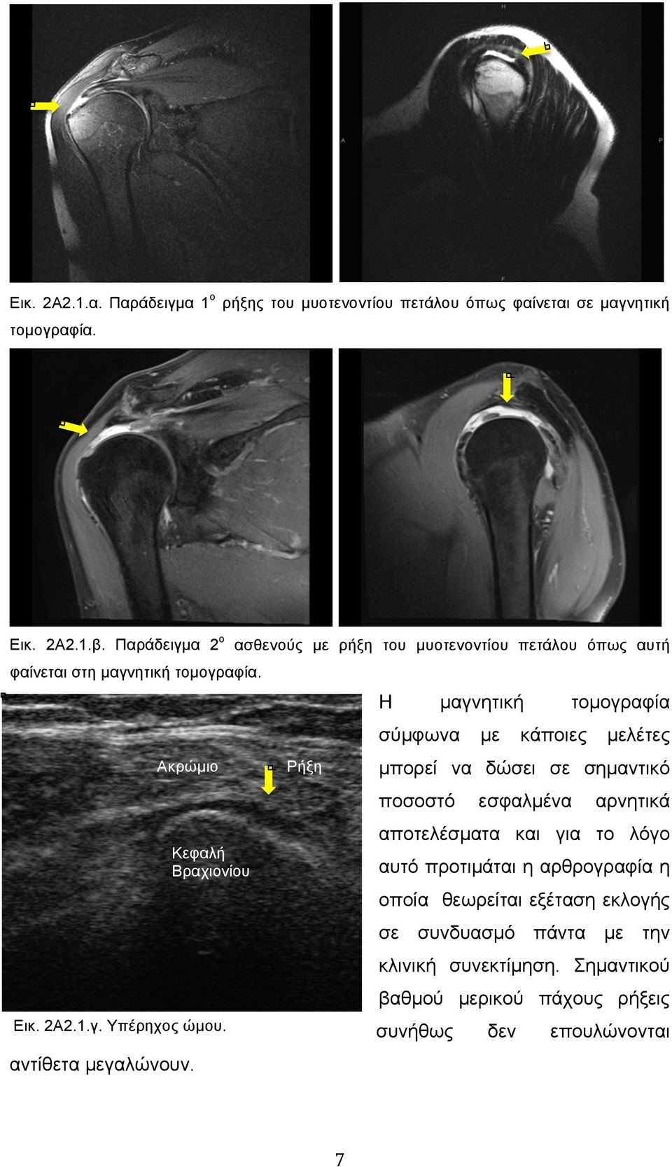 ασθενούς µε ρήξη του µυοτενοντίου πετάλου όπως αυτή Ρήξη Η µαγνητική τοµογραφία σύµφωνα µε κάποιες µελέτες µπορεί να δώσει σε σηµαντικό ποσοστό