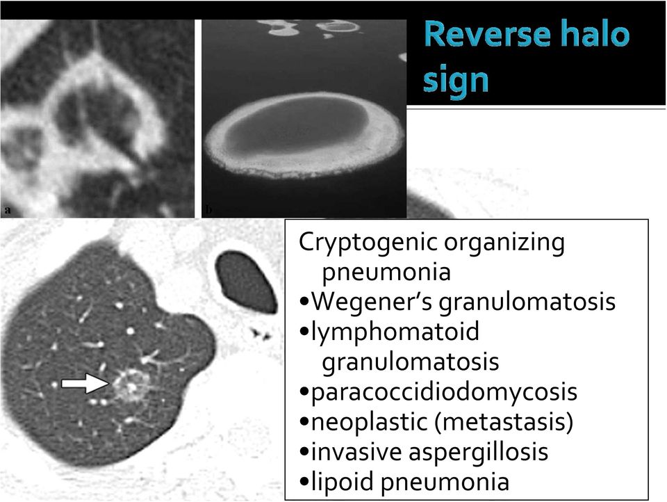 paracoccidiodomycosis neoplastic