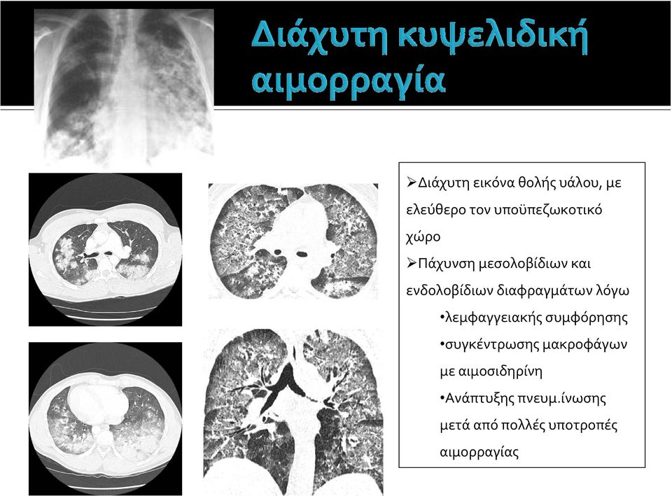 λεμφαγγειακής συμφόρησης συγκέντρωσης μακροφάγων με