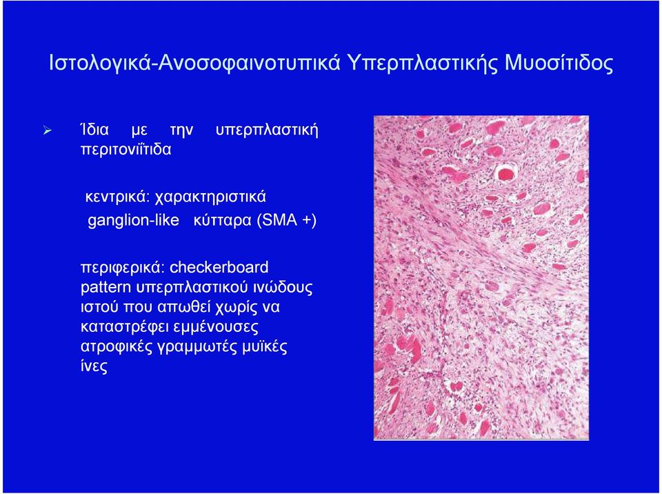 κύτταρα (SMA +) περιφερικά: checkerboard pattern υπερπλαστικού ινώδους