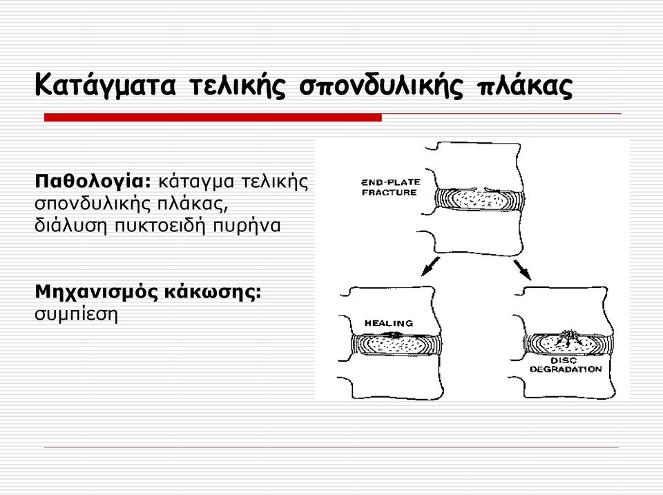 σπονδυλικής πλάκας, διάλυση