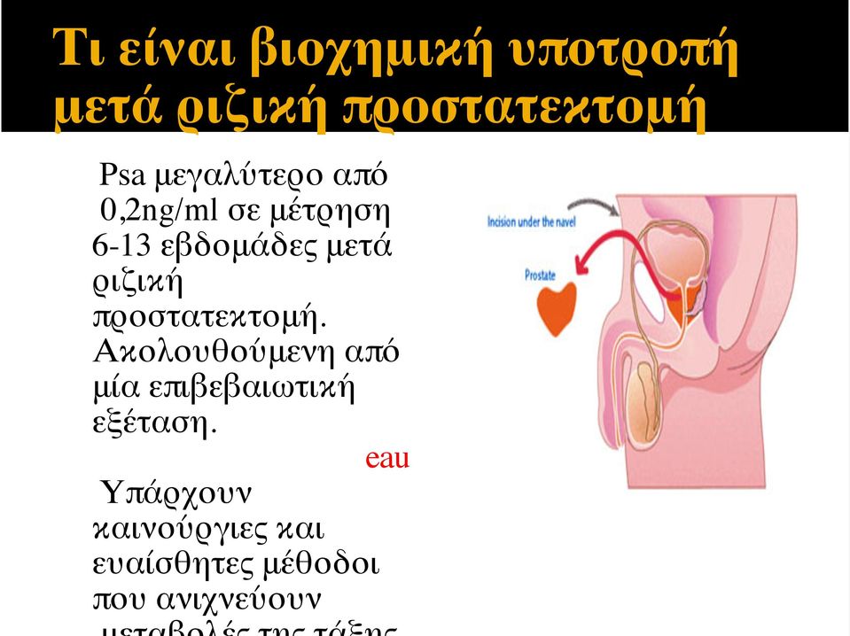 ριζική προστατεκτομή.