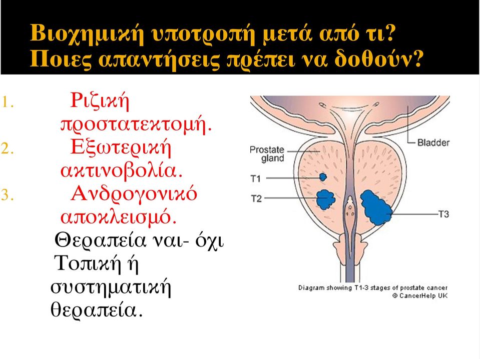 Ριζική προστατεκτομή. 2. Εξωτερική ακτινοβολία.