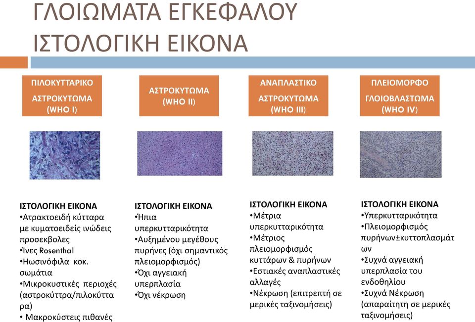 σωμάτια Μικροκυστικές περιοχές (αστροκύττρα/πιλοκύττα ρα) Μακροκύστεις πιθανές ΙΣΤΟΛΟΓΙΚΗ ΕΙΚΟΝΑ Ήπια υπερκυτταρικότητα Αυξημένου μεγέθους πυρήνες (όχι σημαντικός πλειομορφισμός) Όχι αγγειακή