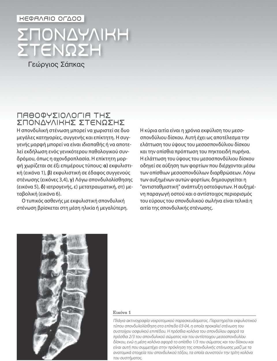 Η επίκτητη μορ φή χωρίζεται σε έξι επιμέρους τύπους: α) εκφυλιστι κή (εικόνα 1), β) εκφυλιστική σε έδαφος συγγενούς στένωσης (εικόνες 3,4), γ) Λόγω σπονδυλολίσθησης (εικόνα 5), δ) ιατρογενής, ε)