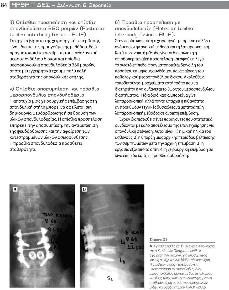 Εδώ πραγματοποιείται αφαίρεση του παθολογικού μεσοσπονδύλιου δίσκου και οπίσθια μεσοσπονδύλια σπονδυλοδεσία 360 μοιρών, οπότε μετεγχειρητικά έχουμε πολύ καλή σταθερότητα της σπονδυλικής στήλης.
