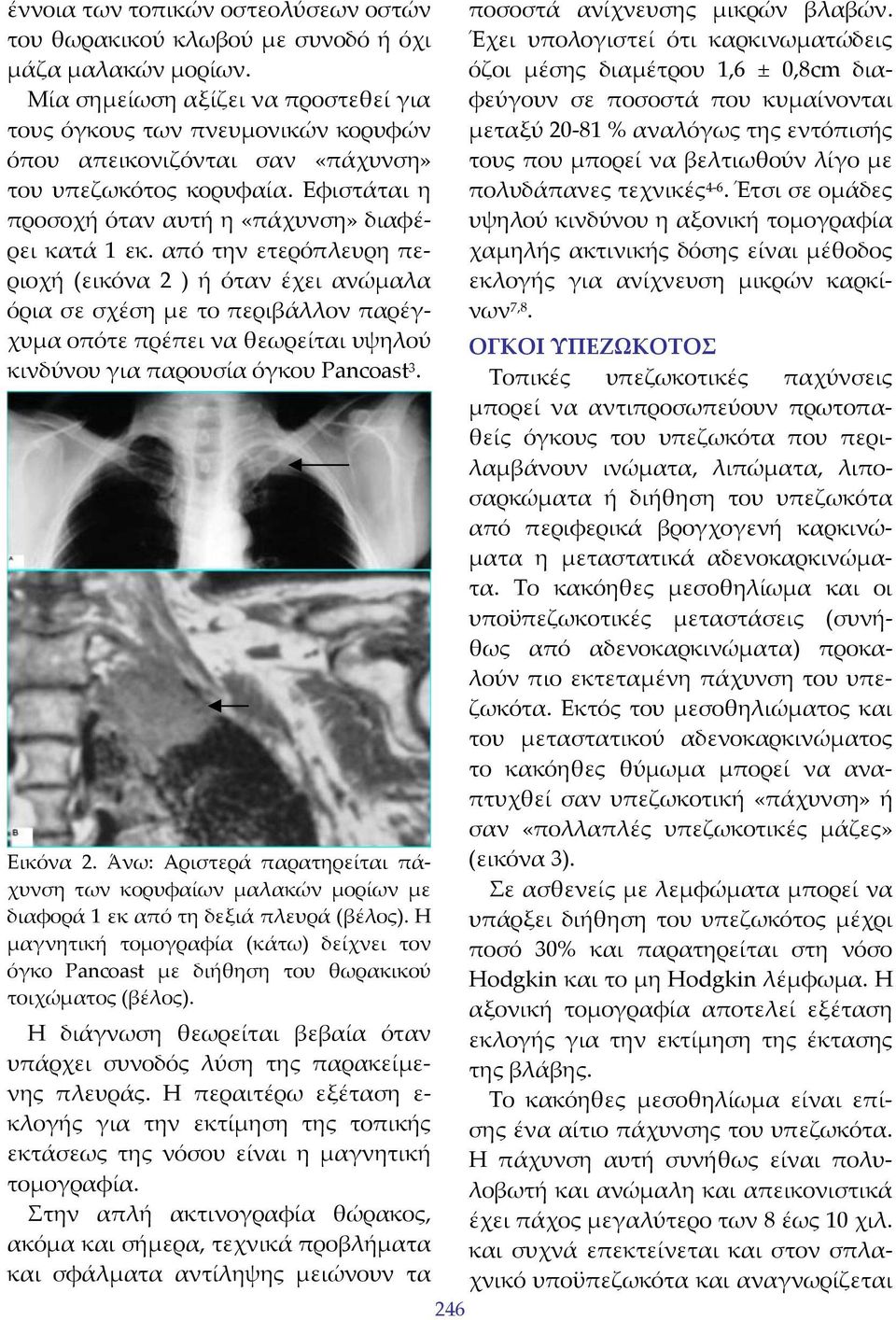από την ετερόπλευρη περιοχή (εικόνα 2 ) ή όταν έχει ανώμαλα όρια σε σχέση με το περιβάλλον παρέγχυμα οπότε πρέπει να θεωρείται υψηλού κινδύνου για παρουσία όγκου Pancoast 3. Εικόνα 2.