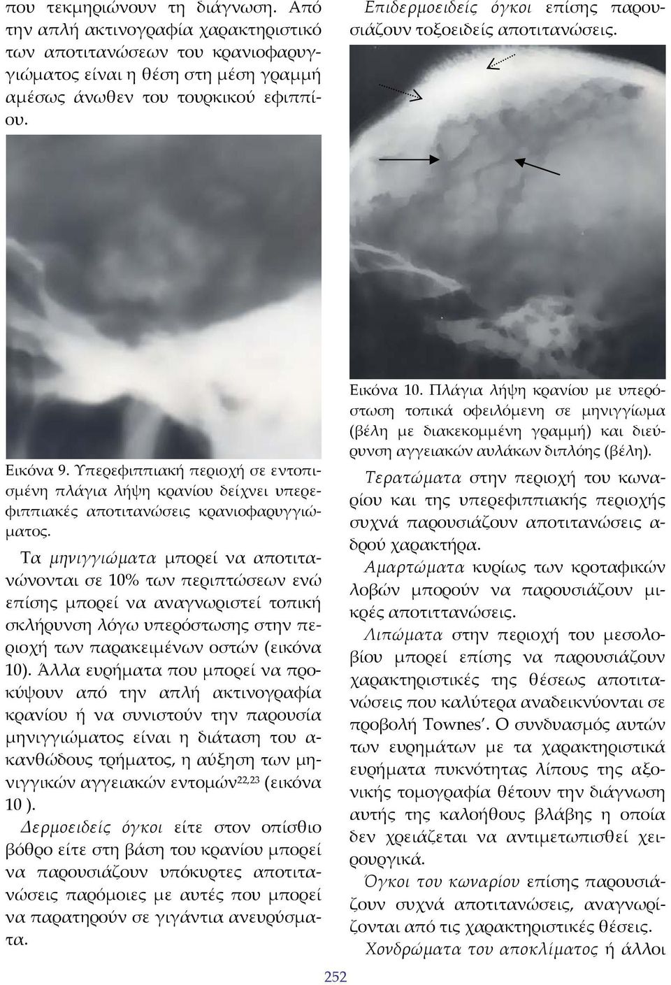 Τα μηνιγγιώματα μπορεί να αποτιτανώνονται σε 10% των περιπτώσεων ενώ επίσης μπορεί να αναγνωριστεί τοπική σκλήρυνση λόγω υπερόστωσης στην περιοχή των παρακειμένων οστών (εικόνα 10).