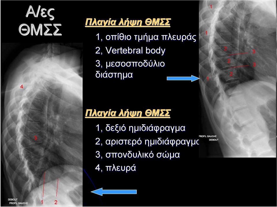 διάστημα Πλαγία λήψη ΘΜΣΣ 1, δεξιό