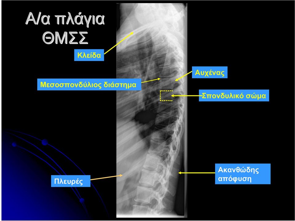 διάστημα Σπονδυλικό