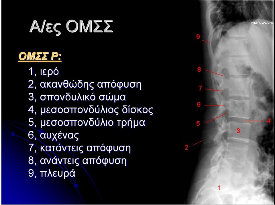 μεσοσπονδύλιος δίσκος 5, μεσοσπονδύλιο